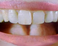 Dente recriado é menos rígido que o dente humano natural
