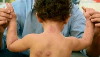 Criança foi mordida nos braços, pernas, costas, peito, pescoço e cabeça