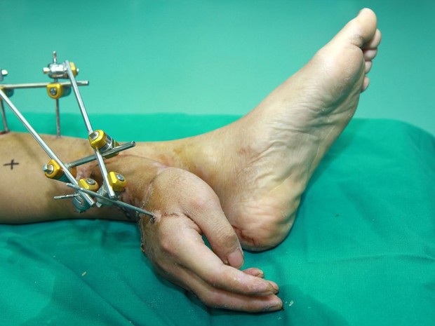 Chinês teve mão reimplantada junto ao tornozelo para membro receber fluxo sanguíneo (Foto: HAP/Quirky China News/Rex Images)