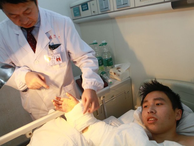 Após um mês com a mão junto ao tornozelo, chinês teve mão reimplantada no braço (Foto: HAP/Quirky China News/Rex)