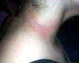 Gabbie, de 13 anos, sofreu queimaduras após curto-circuito de aparelho celular.